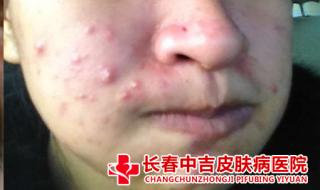 上海看痤疮看得好的医院 治疗痤疮最好的医院